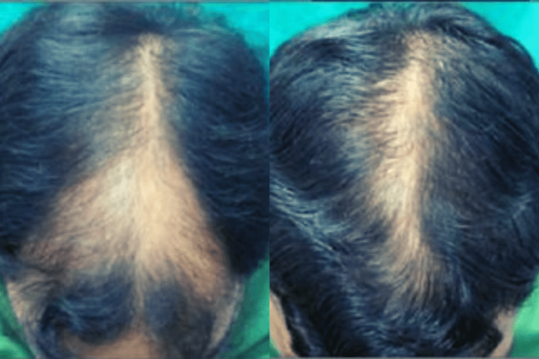 Microneedling For Hair Loss - Pro Needling