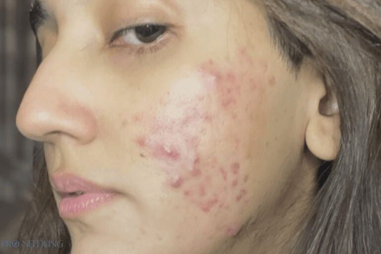 I Tried Microneedling For Acne Scars